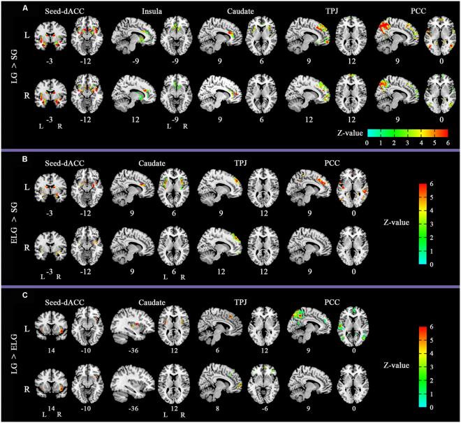 Altered functional connectivity (FC) pattern in comparison across the three groups. Front. Hum. Neurosci.