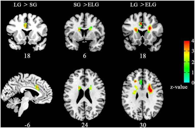 Brain areas with altered regional homogeneity (ReHo) the in-love group (LG) and ended-love group (ELG). Front. Hum. Neurosci.